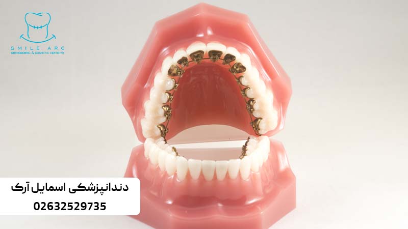 مزایای ارتودنسی نامرئی