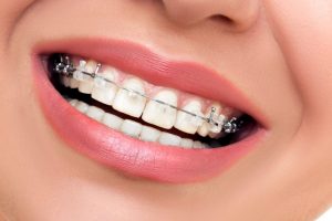 عوامل موثر در هزینه ارتودنسی