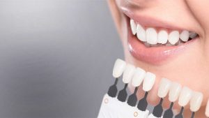 مزایا و معایب بلچینگ دندان