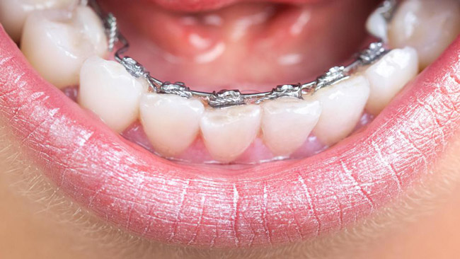 تفاوت ارتودنسی لینگوال و معمولی