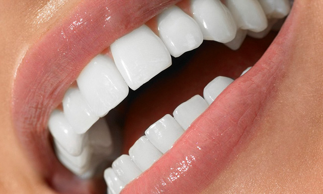 لمینت دندان در کرج