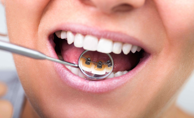 ارتودنسی لینگوال دندان چیست؟