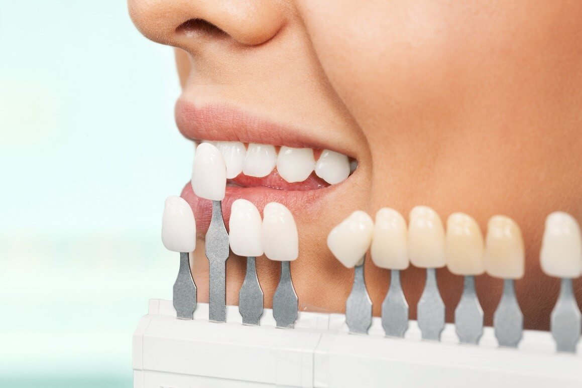 هزینه کامپوزیت دندان در کرج