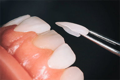 تفاوت لمینت و کامپوزیت دندان
