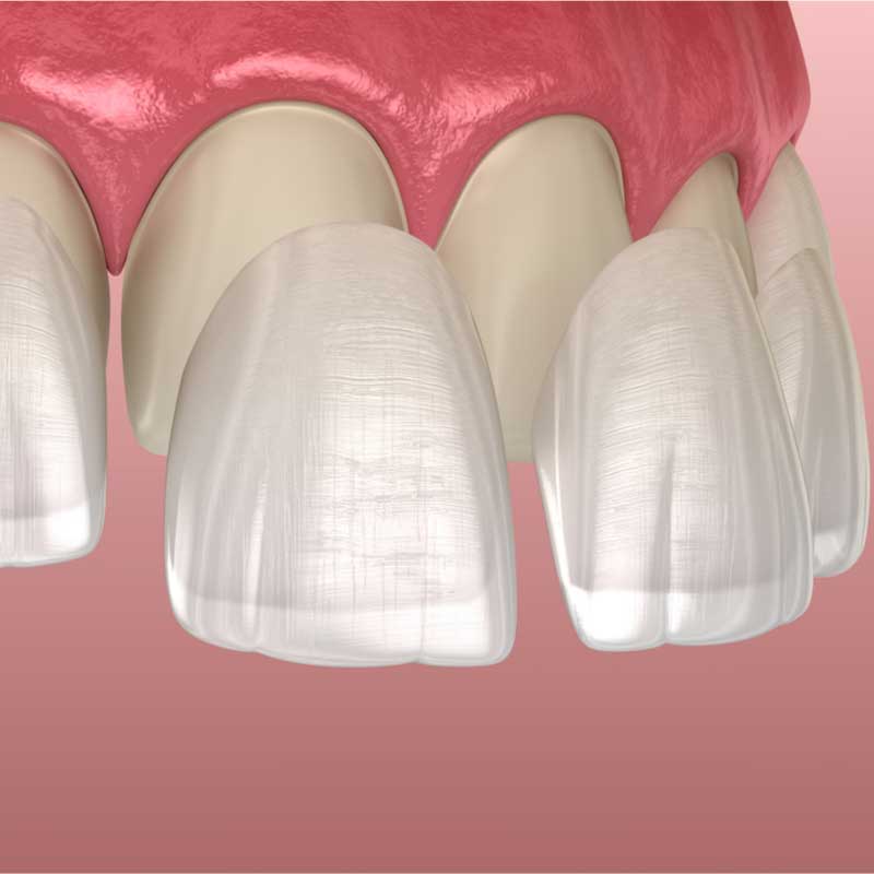 تفاوت لمینت و کامپوزیت دندان