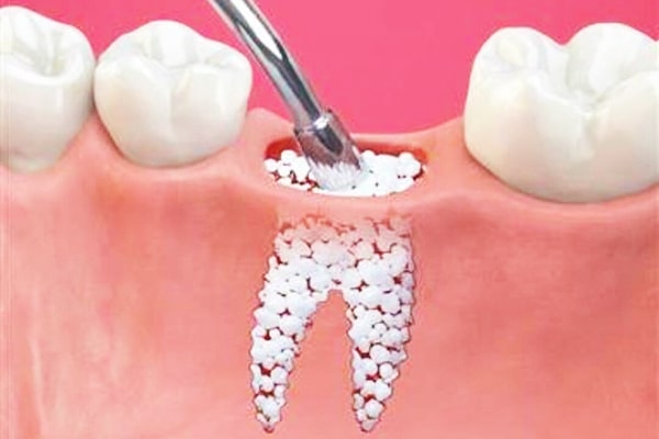 پیوند استخوان فک برای کاشت ایمپلنت