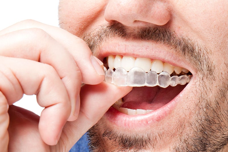 ارتودنسی متحرک دندان در کرج