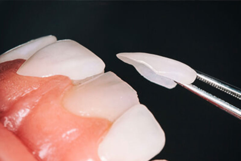 متخصص لمینت دندان در کرج