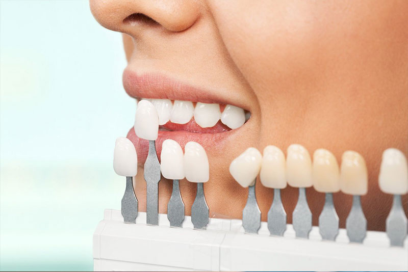 متخصص لمینت دندان در کرج
