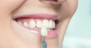 برسی انواع روکش دندان