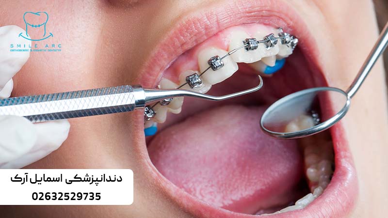 ارتودنسی و پوسیدگی دندان