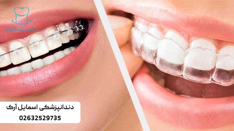 اصلاح طرح لبخند با ارتودنسی