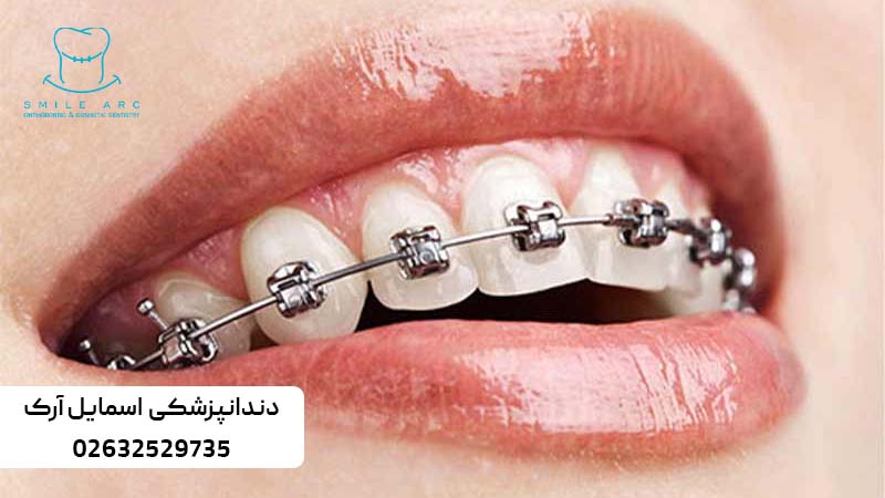 اصلاح طرح لبخند با ارتودنسی