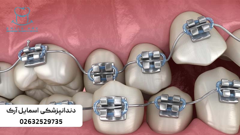 اصلاح طرح لبخند با ارتودنسی