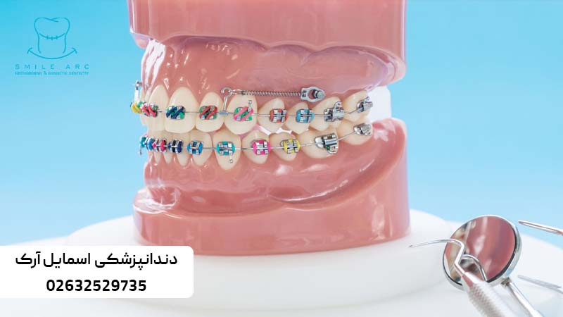 اصلاح طرح لبخند با ارتودنسی