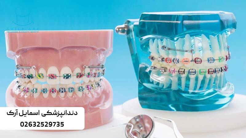 اصلاح طرح لبخند با ارتودنسی