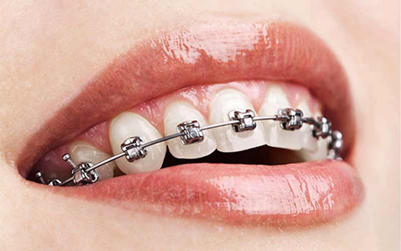 ارتودنسی-دندان-چیست؟