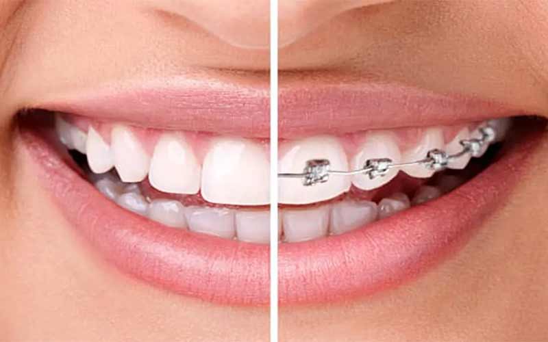 ارتودنسی-یا-لمینت-دندان