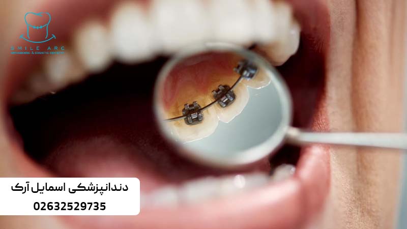 ارتودنسی ثابت پشت دندان