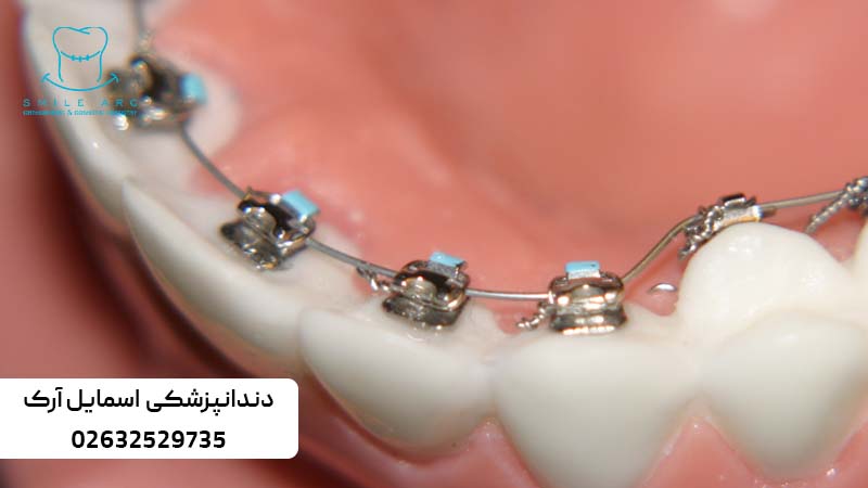 ارتودنسی ثابت پشت دندان