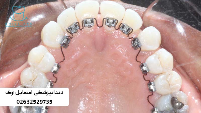 ارتودنسی ثابت پشت دندان