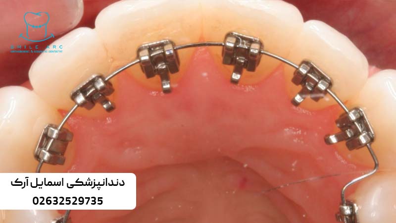 ارتودنسی دندان روکش شده