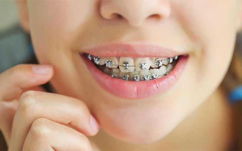 ارتودنسی-ثابت-دندان