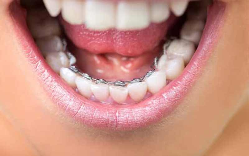 ارتودنسی-ثابت-پشت-دندان-چیست؟