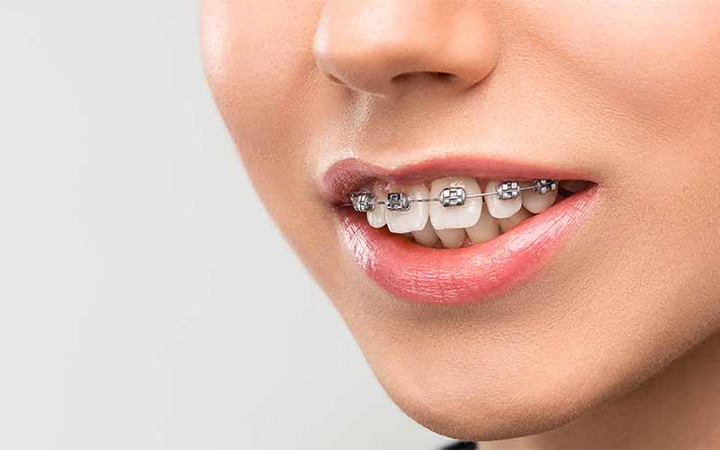 Orthodontics-of-4-teeth
