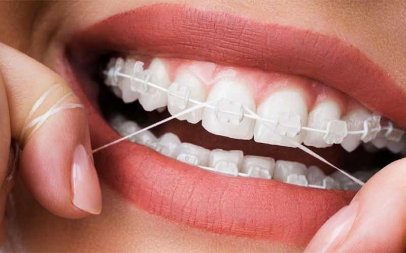 نخ-دندان-ارتودنسی