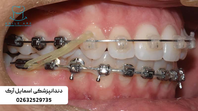 ارتودنسی ثابت دیمون