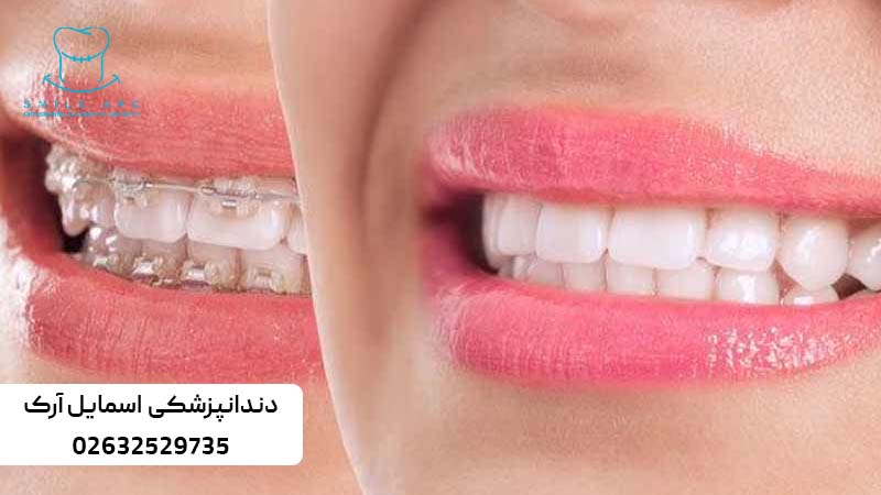 بهترین روش ارتودنسی