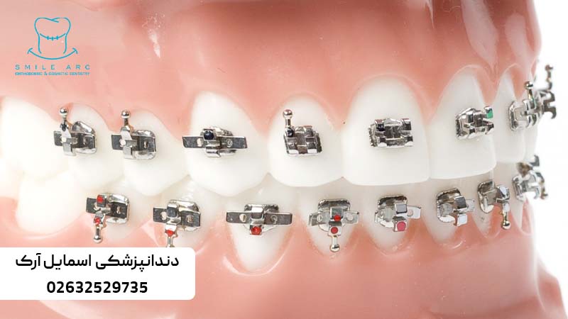 ارتودنسی ثابت دیمون