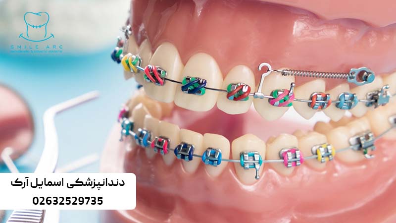 ارتودنسی ثابت دیمون
