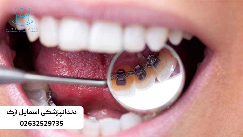 بهترین روش ارتودنسی