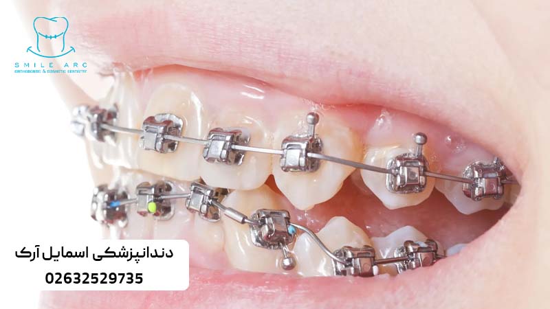 ارتودنسی ثابت دیمون