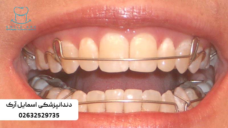 پلاک و نگهدارنده ثابت بعد از ارتودنسی