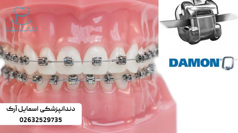 ارتودنسی ثابت دیمون