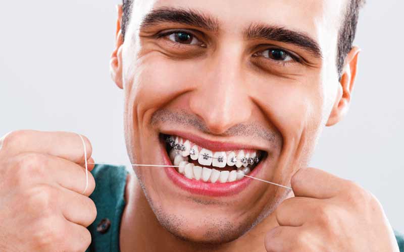 مراقبت-از-بریس-های-ثابت