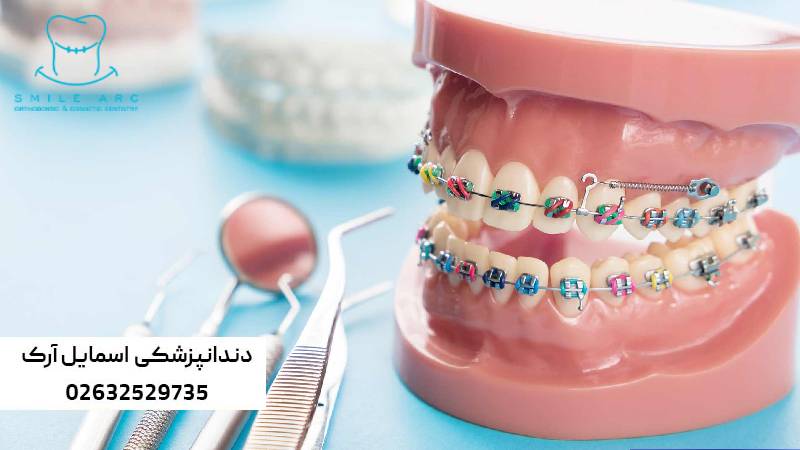 بهترین روش ارتودنسی