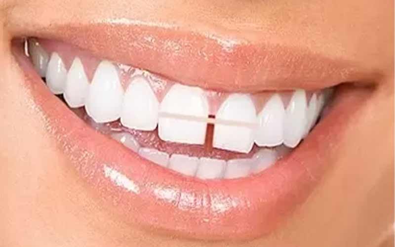 خطرات-یک-دندان-کج