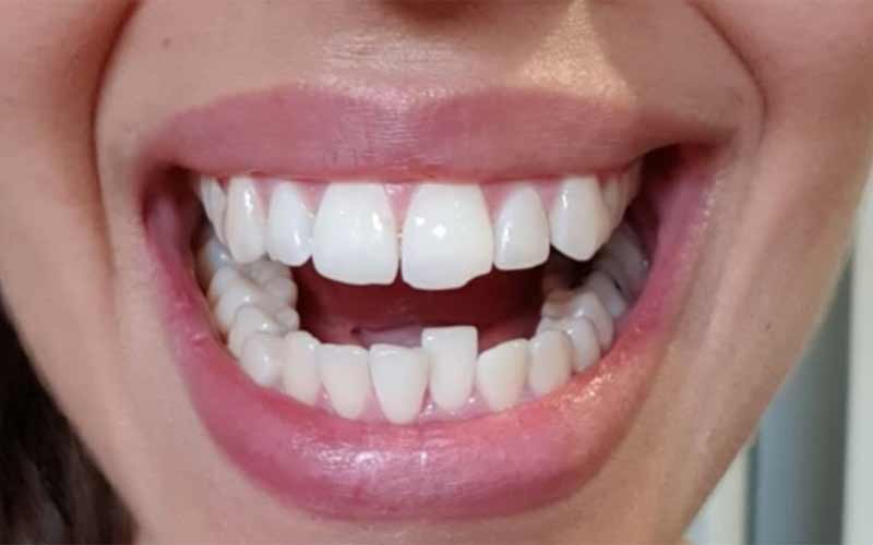 دلایل-کج-شدن-یک-دندان