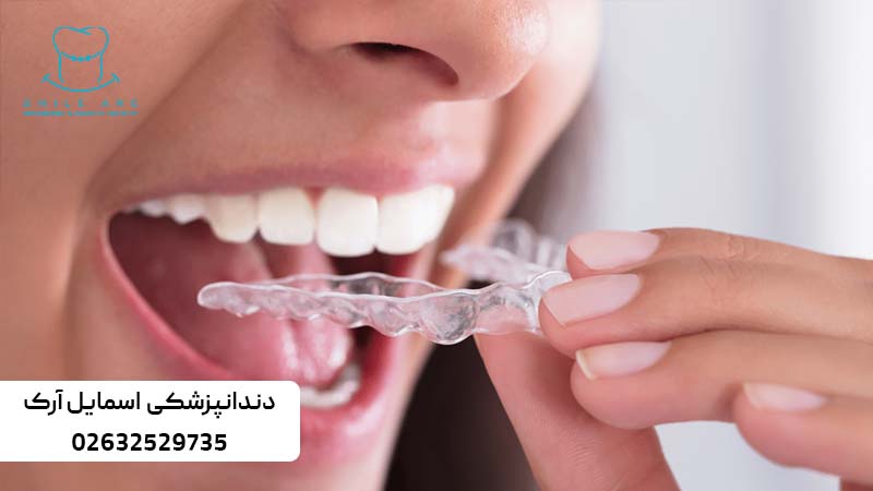 نایت گارد یا محافظ دندان چیست