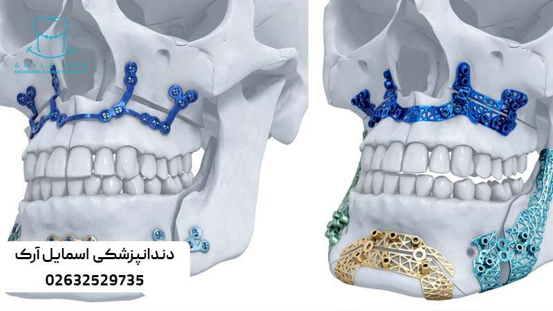 هزینه جراحی فک و ارتودنسی