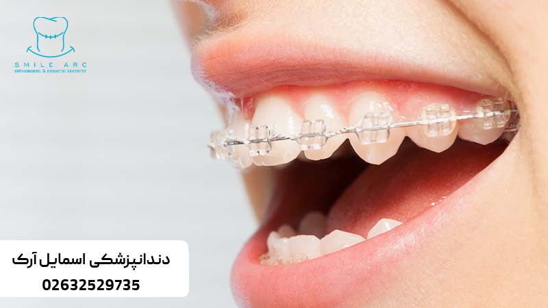 انجام همزمان ارتودنسی و ایمپلنت دندان