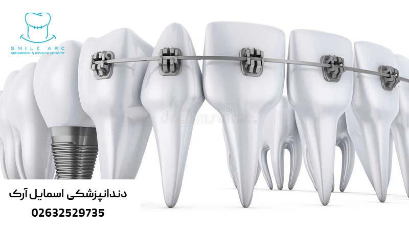 انجام همزمان ارتودنسی و ایمپلنت دندان