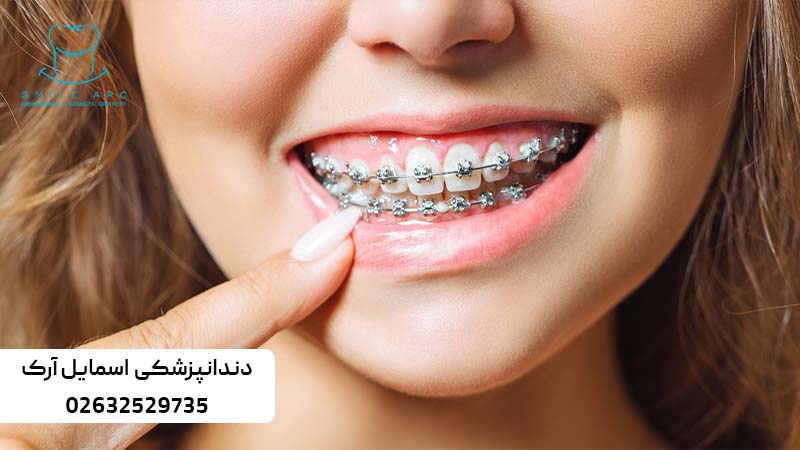 ارتودنسی دندان نیش نهفته