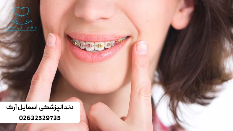 ارتودنسی دندان نیش نهفته