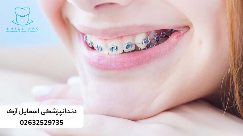 ارتودنسی دندان نیش نهفته