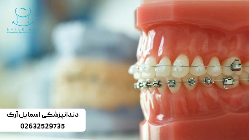 ارتودنسی دندان نیش نهفته